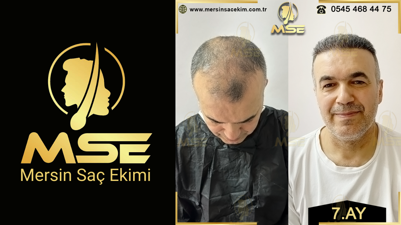 Mersin Saç Ekimi